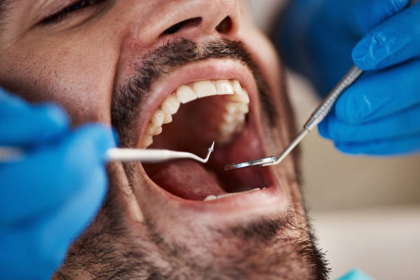 Best Emergency Treatment for Dental Infections or Abscesses in Marshalltown, IA