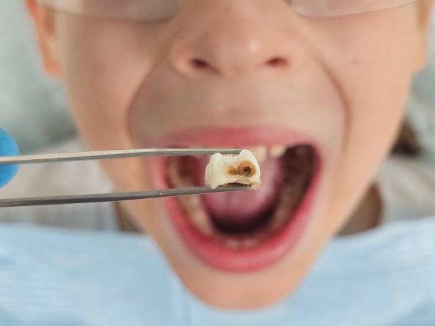 Best Emergency Dental Care for Broken or Chipped Teeth in Marshalltown, IA