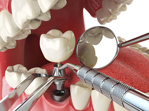Best Emergency Denture Repair in Marshalltown, IA